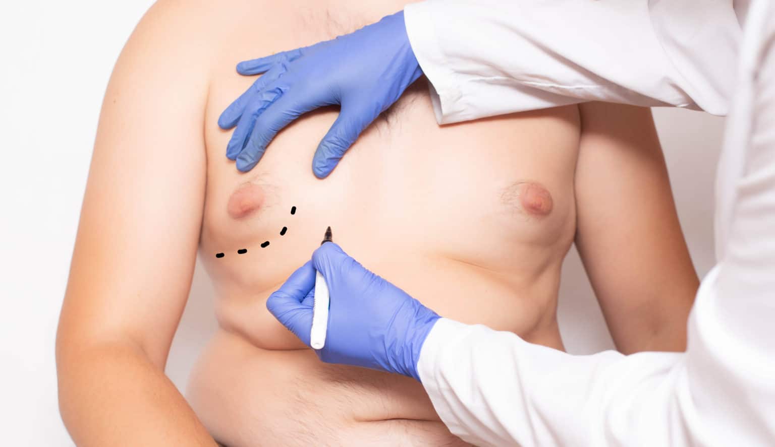 gynekomasti bröstreduktion för män