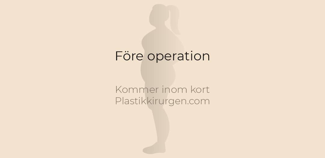 placeholder fore operation