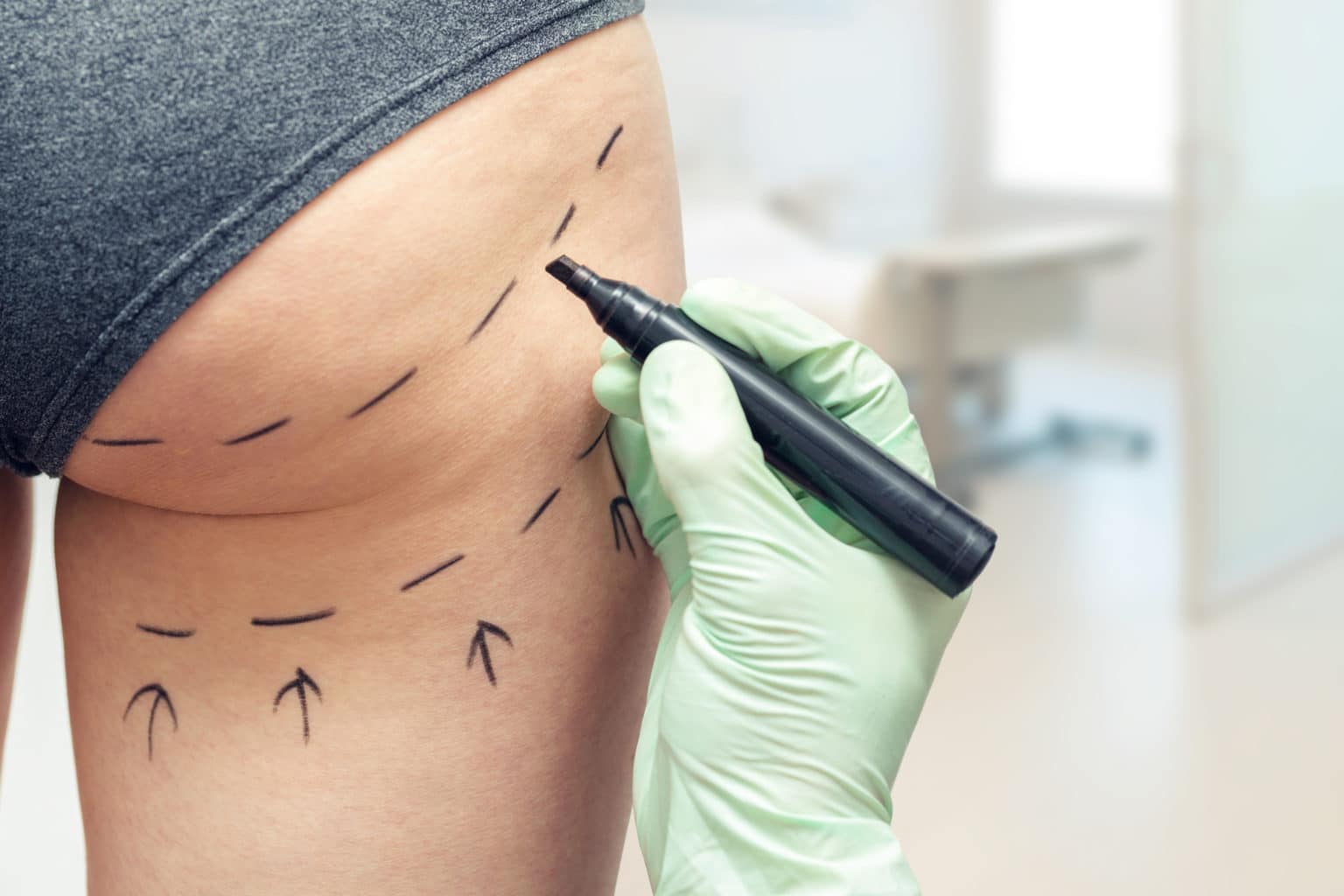 Plastikkirurg som ritar upp linjer på kvinnas bakdel under en konsultation inför lårplastik med rumplyft