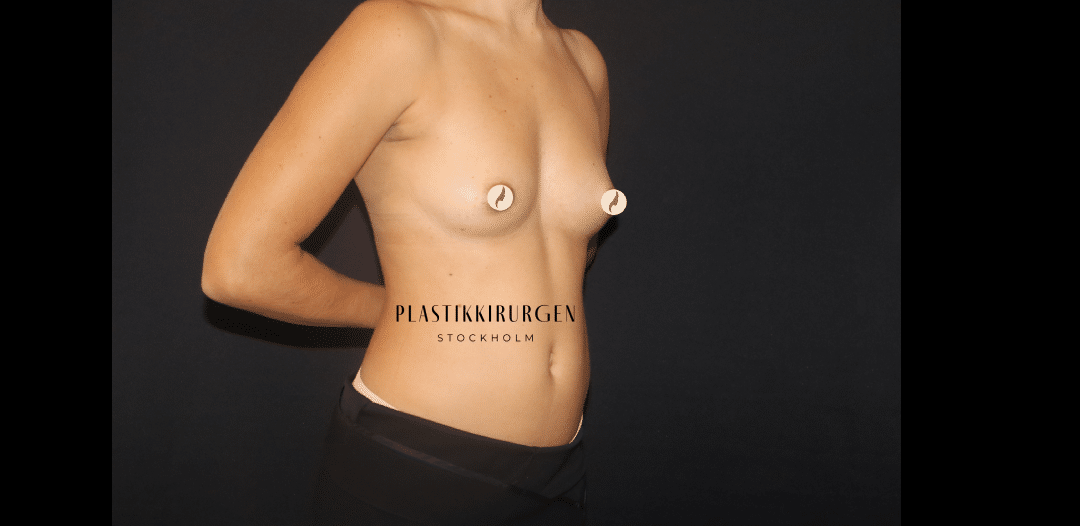 bröstförstoring implantat före