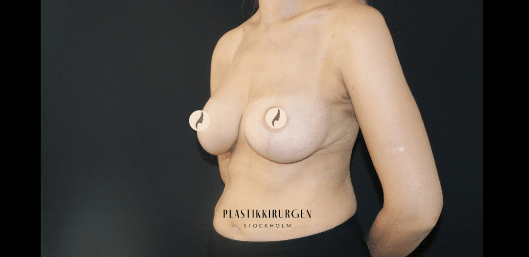 Bröstförstoring med bröstlyft efter