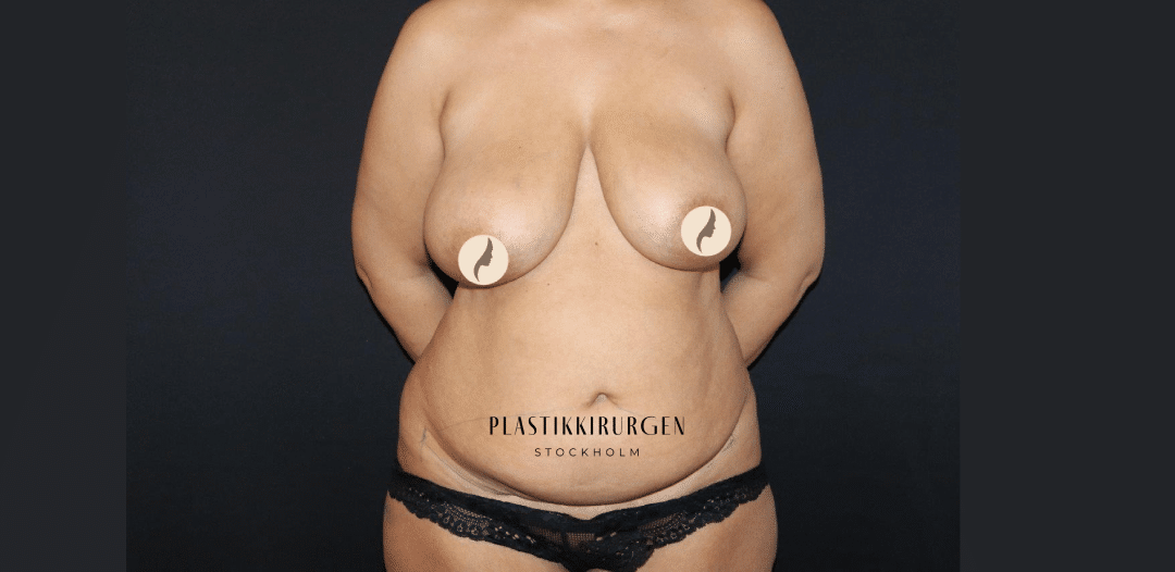 bröstlyft bukplastik före