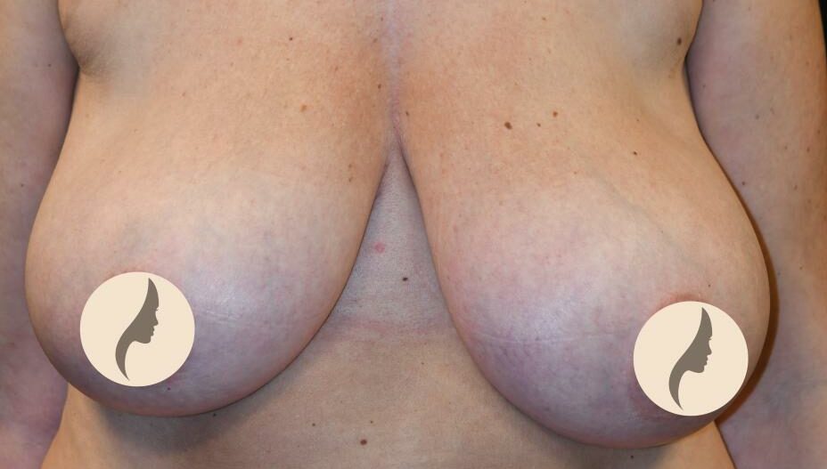 Bröstförminskning före