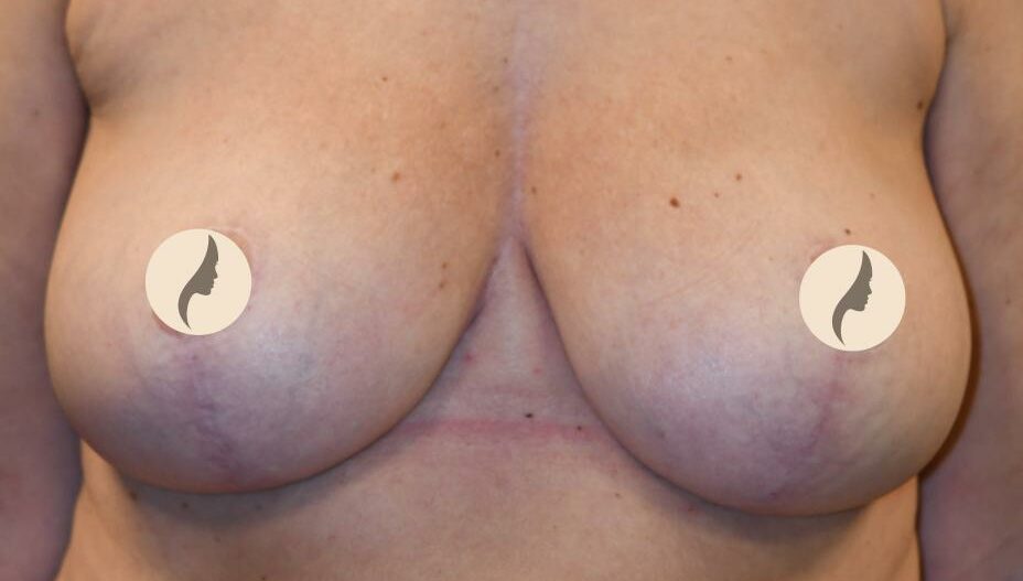 Bröstförminskning efter