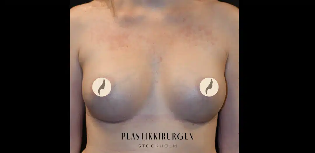Bröstförstoring efter