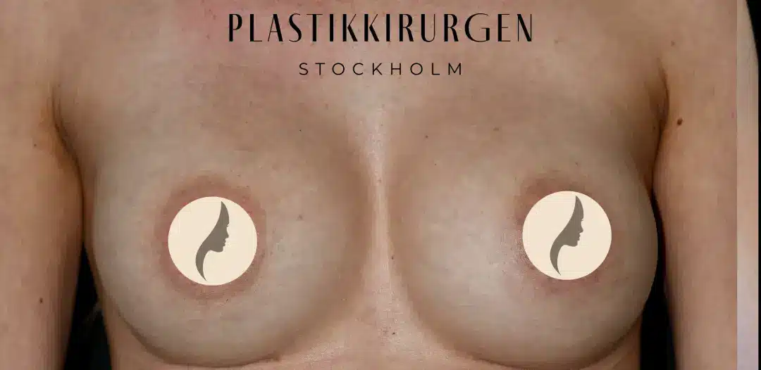 brostforstoring 53 efter