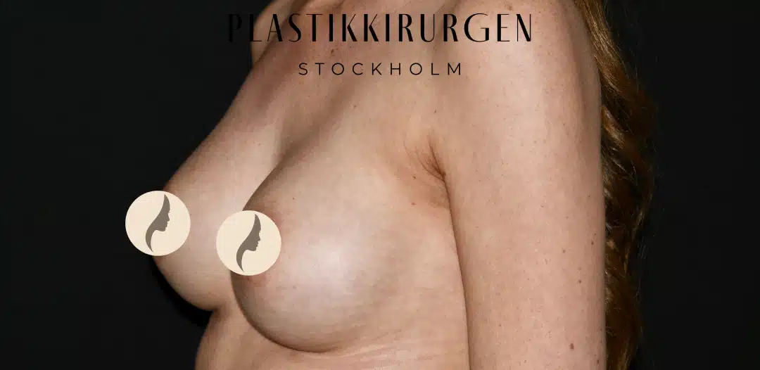brostforstoring 54 efter