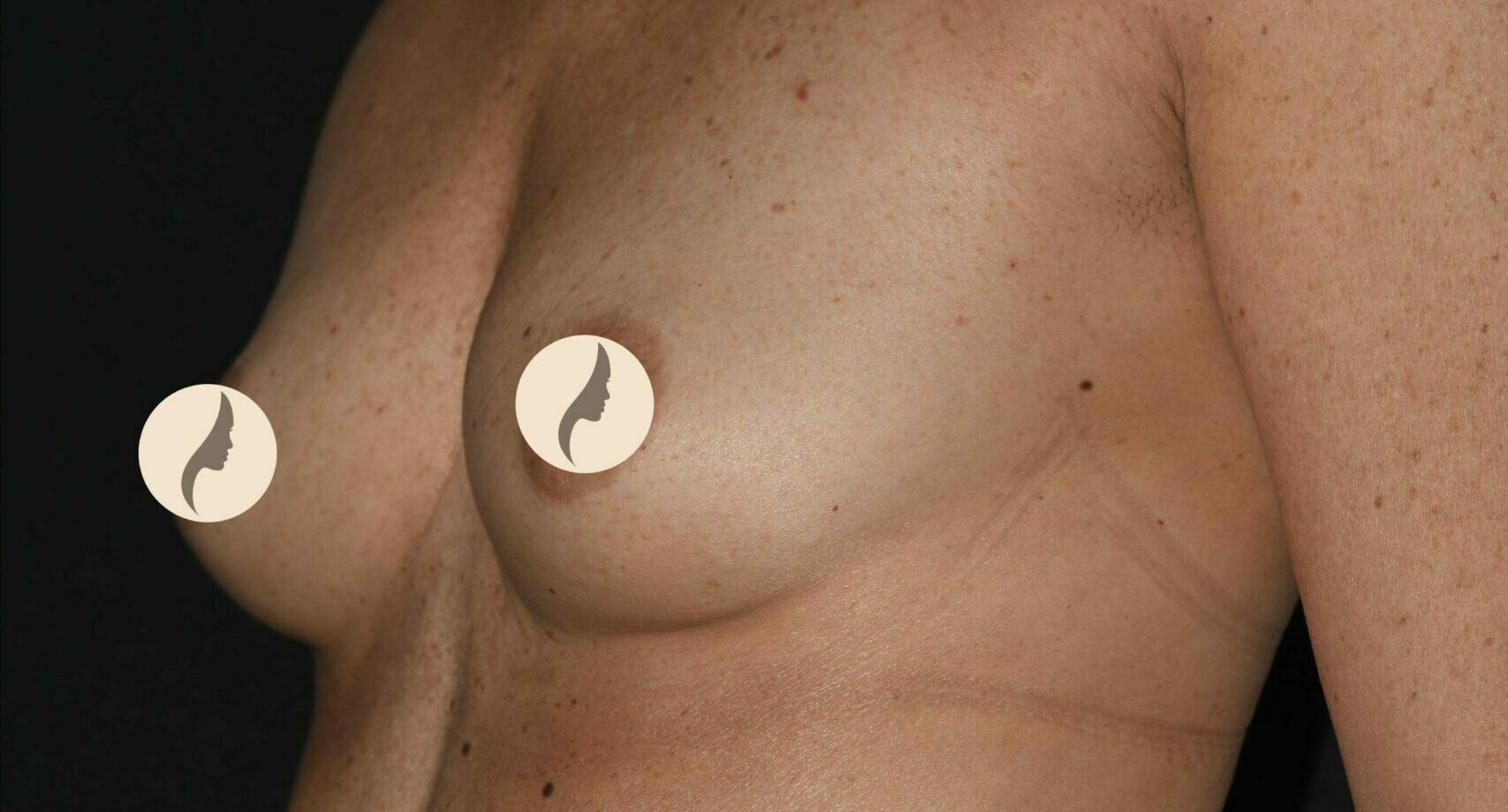 Bröstförstoring Mentor THM+P 270 cc