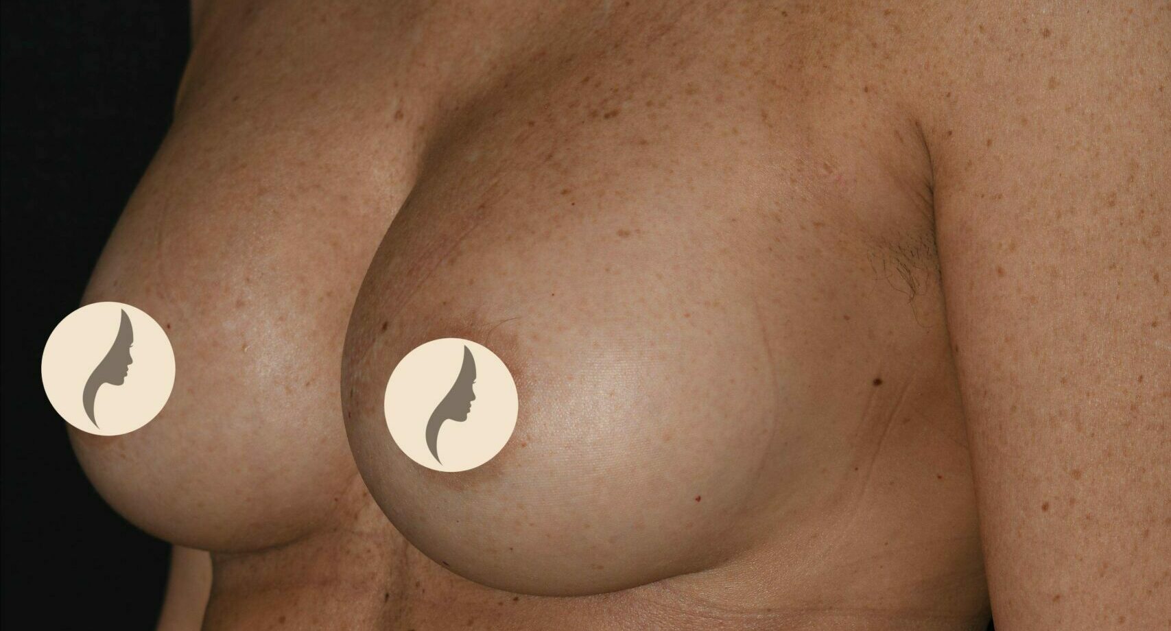 Bröstförstoring Mentor THM+P 270 cc