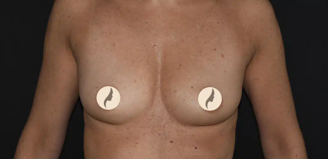 Bröstförstoring Mentor THM+P 270 cc