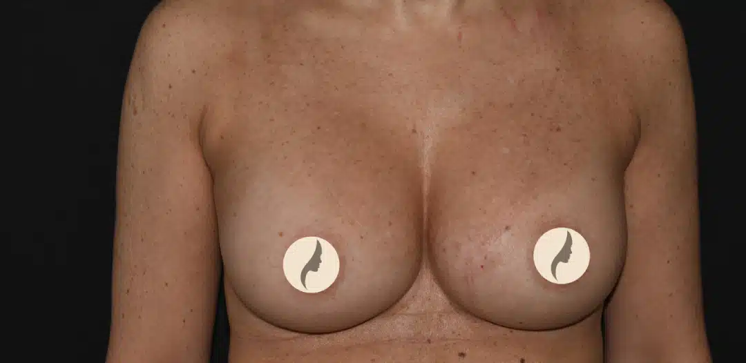 Bröstförstoring Mentor THM+P 270 cc