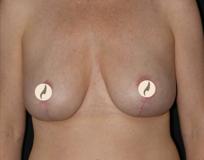 bröstförminskning efter