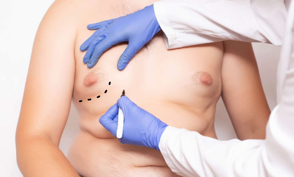 gynekomasti bröstreduktion för män